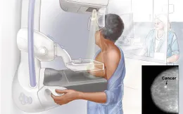 Chụp mammogram để phát hiện ung thư vú sớm