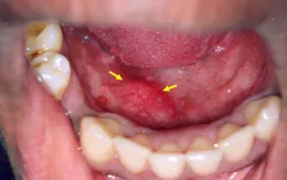 Những căn bệnh ung thư lạ lùng ít người biết