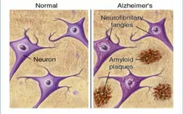 Tìm ra cách phát hiện Alzheimer trước 15 năm