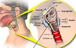 Nhận biết sớm ung thư thanh quản