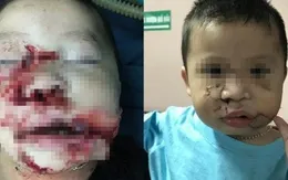 Bé trai 2 tuổi bị chó cắn nát mặt