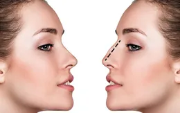 Những điều cần biết về phẫu thuật thẩm mỹ mũi