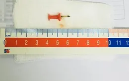 Phát hiện đinh ghim sắt trong phế quản bé gái 12 tuổi