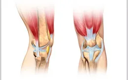 Tư vấn và khám bệnh miễn phí chấn thương dây chằng khớp gối