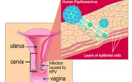 Vi rút HPV có nguy hiểm không?