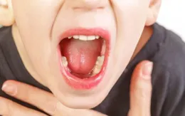 Hạch cổ dưới hàm có thể là dấu hiệu cảnh báo ung thư vòm họng