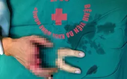 Tận mắt xem hai ngón tay bị đứt rời vì tai nạn được nối lại