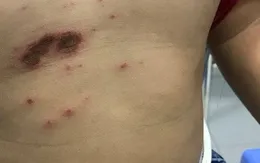 Gia tăng nhiễm trùng da ở trẻ em