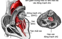 Cứu sống mẹ con sản phụ bị bệnh tim nặng kèm theo khối u xơ tử cung nặng 4kg