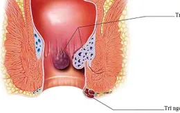 Bệnh trĩ không xấu - Tại sao phải giấu?