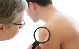Liệu pháp điều trị ung thư da bằng virus herpes biến đổi gen
