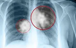 Xét nghiệm DNA giúp chống lại bệnh lao ở Madagascar
