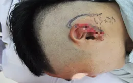Đang trong cuộc nhậu, người đàn ông bị cắn đứt tai