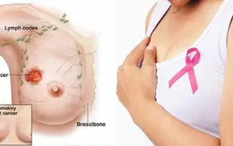 Dấu hiệu cảnh báo ung thư vú, mọi chị em nên biết