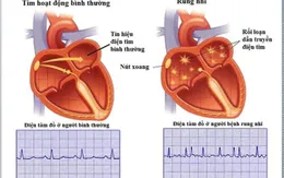 Rung nhĩ: Những điều người bệnh tim cần biết