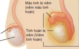 Viêm tinh hoàn: Biến chứng nguy hiểm nếu không điều trị kịp thời