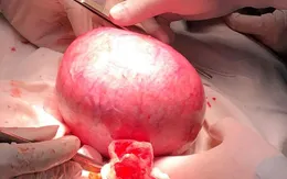 Đau bụng dưới, mệt mỏi, đi khám phát hiện u xơ tử cung nặng 2,7kg