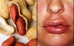 Phương pháp xét nghiệm máu chẩn đoán dị ứng lạc