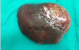 Ca bệnh hiếm: Khối u gan 5kg ở bệnh nhân u cơ mỡ mạch gan