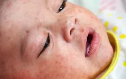 Nhận diện bệnh sởi khi mới vào hè