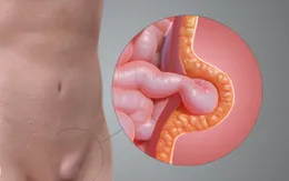 Thoát vị bẹn ở trẻ nhỏ - Đừng để chậm trễ
