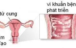 Hầu hết phụ nữ mắc bệnh nhiễm khuẩn âm đạo