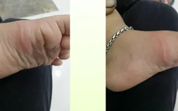 Giun kim di chuyển lúc nhúc dưới da bé gái 5 tuổi