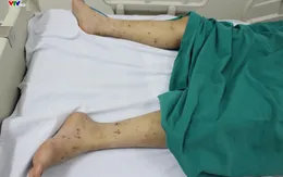 Vì sao viêm não mô cầu lại nguy hiểm?