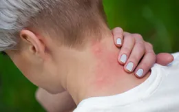 Vì sao một vài người lại bị muỗi đốt nhiều hơn người khác?