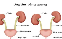Máu trong nước tiểu cảnh báo ung thư bàng quang ít người biết