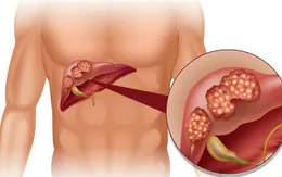 Việt Nam có tỷ lệ mắc ung thư gan cao thứ 5 thế giới