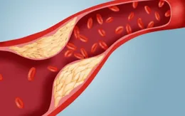Điểm mặt các nguyên nhân gây tăng mỡ máu