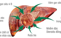 Nguyên nhân gây ung thư gan ít người biết