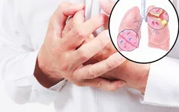 Điều trị viêm phế quản mạn bằng Đông y
