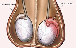Viêm tuyến tiền liệt ở nam giới có thể gây vô sinh