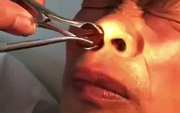 Gắp đỉa trong lỗ mũi bệnh nhân