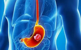 12 nguyên nhân gây ung thư dạ dày được các chuyên gia cảnh báo