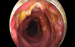 Nữ bệnh nhân bị nhiễm trùng máu do viêm ruột nặng