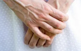 Những điều cần biết về bệnh suy giãn tĩnh mạch tay