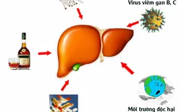 Nguyên nhân gây ung thư gan, ít người biết