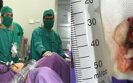 Cắt khối u quái có tóc, da, xương...trong tử cung bé gái 12 tuổi