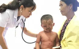 Bé trai 2 tuổi bị viêm da mủ toàn thân, loét hết mặt vì tắm nước lá