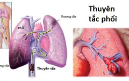 Thuyên tắc phổi - Bệnh do nằm bất động quá lâu có thể gây tử vong
