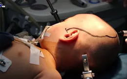 Phẫu thuật thành công cho bệnh nhi động kinh kháng thuốc