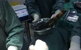 Tắc cà tím trong trực tràng vì chữa bệnh theo cách dân gian