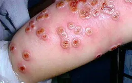 Góc giải đáp: Bệnh đậu mùa khỉ khác gì đậu mùa thường?
