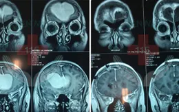Trầm cảm, mất ngủ: Phát hiện u màng não trán