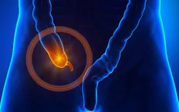 Cảnh giác với dấu hiệu viêm ruột thừa