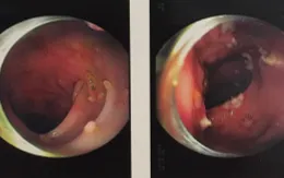 Mới 29 tuổi, người đàn ông bị polyp chằng chịt trong đại tràng