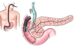 Các triệu chứng dễ bỏ qua của ung thư tụy